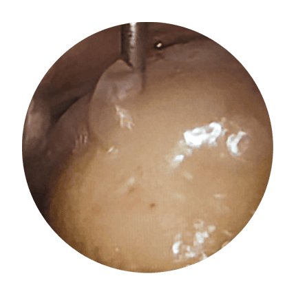Arthroscopic view of the matrix applied into the prepared defect