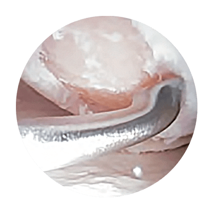 Arthroscopic view of a prepared cartilage defect