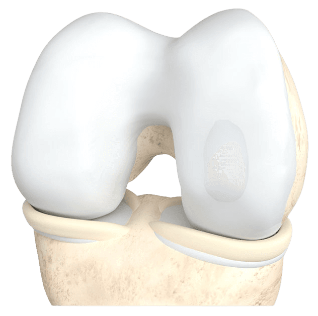 Illustration of a cartilage defect in the knee joint