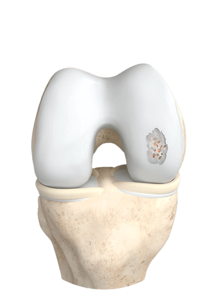 Illustration of identifying a cartilage defect during arthroscopic surgery