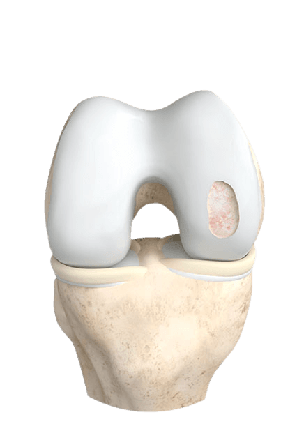 Illustration of preparing a cartilage defect before implantation
