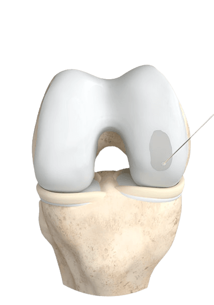 Illustration of ChondroFiller being applied into a prepared cartilage defect