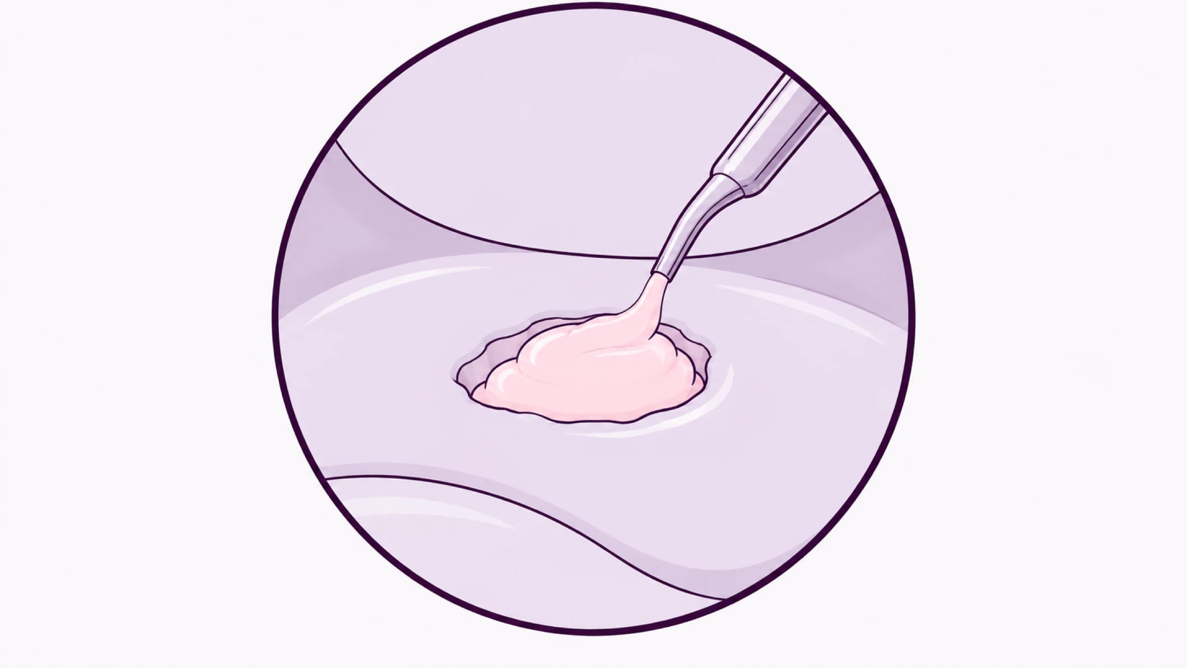 Illustration of an arthroscopic view with a bounded cartilage defect being filled from a cannula